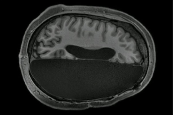 脑机接口|马斯克的“脑机接口”被质疑，脑部植入芯片控制人体，真能成吗？