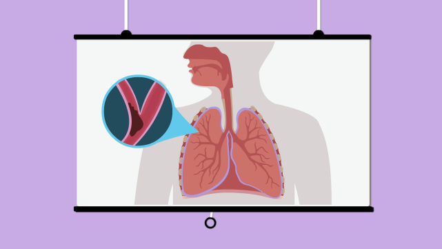 肺栓塞的预防