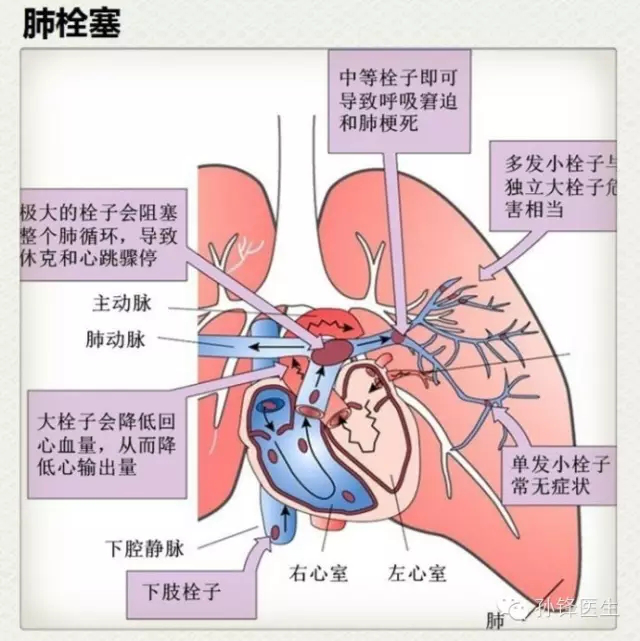 肺栓塞的症状 腾讯新闻