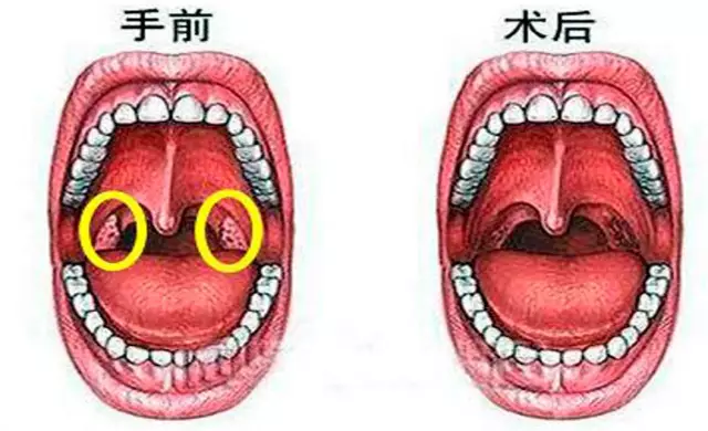 如何治疗扁桃体发炎