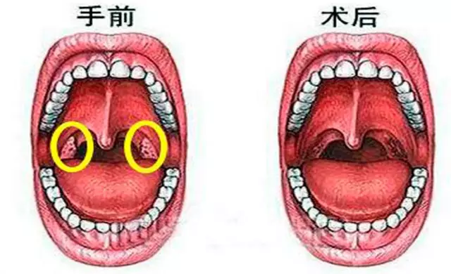 如何治疗扁桃体发炎|咽炎|急性炎症|扁桃体炎