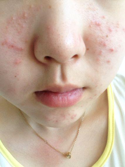 面对丘疹性痤疮该怎么办