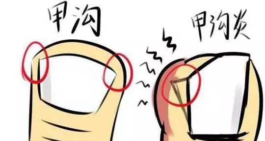 甲沟炎|甲沟炎如何消肿？