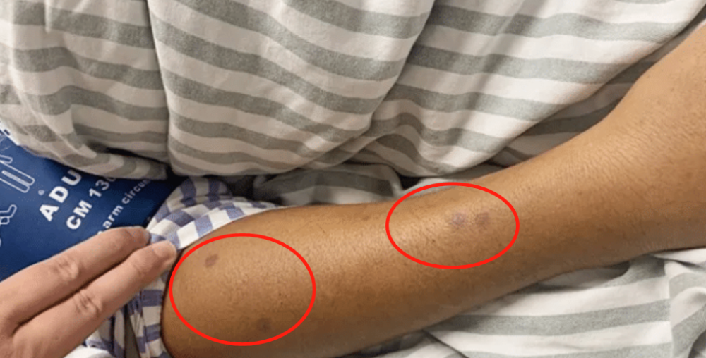 散步进了icu,两天还没脱离生命危险!杭州近一个月有600多人中招