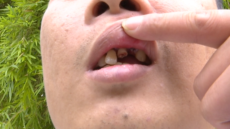 事发后,酒店方带着肖先生到附近医院治疗,经过诊断,肖先生有四颗牙齿