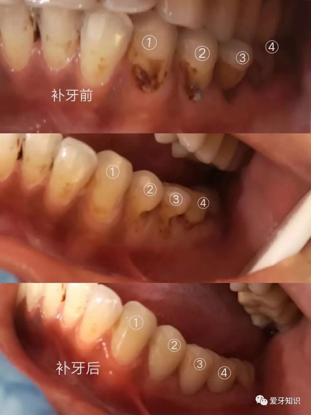 横着刷牙刷出沟的图片图片