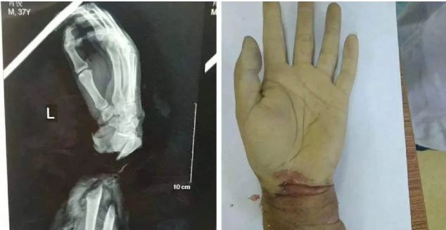 22岁女子为骗800万保险金,锯断了自己的手