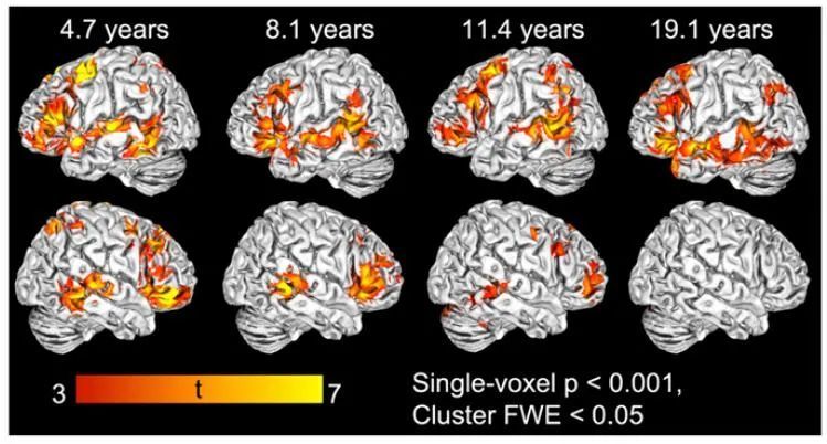 大脑半球|PNAS：与成年人不同，儿童使用两个大脑半球来理解执行语言功能