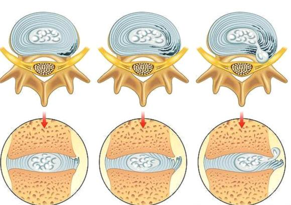腰椎间盘膨胀图片图片