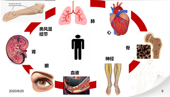 类风湿:即类风湿关节炎,是以慢性关节炎为主要表现的影响全身各系统的