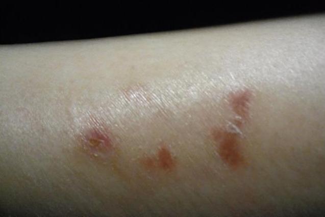 艾灸后起水泡不一定是烫伤!有大作用_腾讯新闻