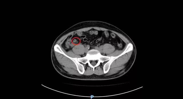 小小阑尾炎没放心上,差点损伤了这个重要器官!