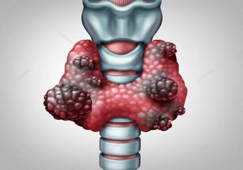 甲状腺结节|警惕！甲状腺结节四大危害，久拖易诱发癌变！