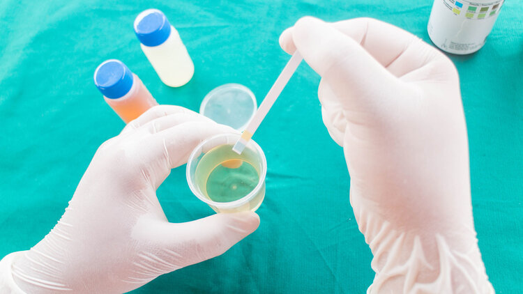 尿蛋白|尿常规中的“＋”号，都是什么意思？教你读懂尿常规里的各种项目