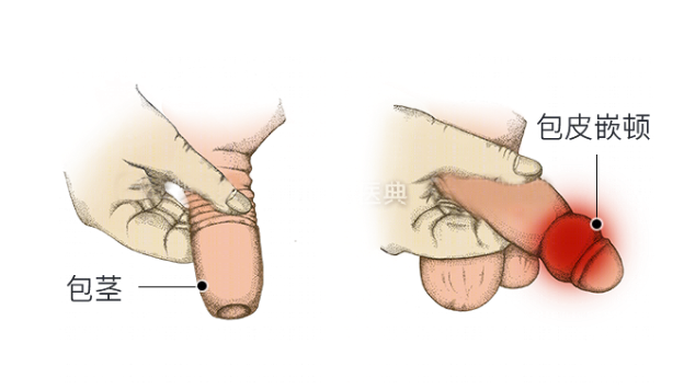 包皮长到底要不要割 医生建议这3种情况还是割了吧 对男女都好 全网搜