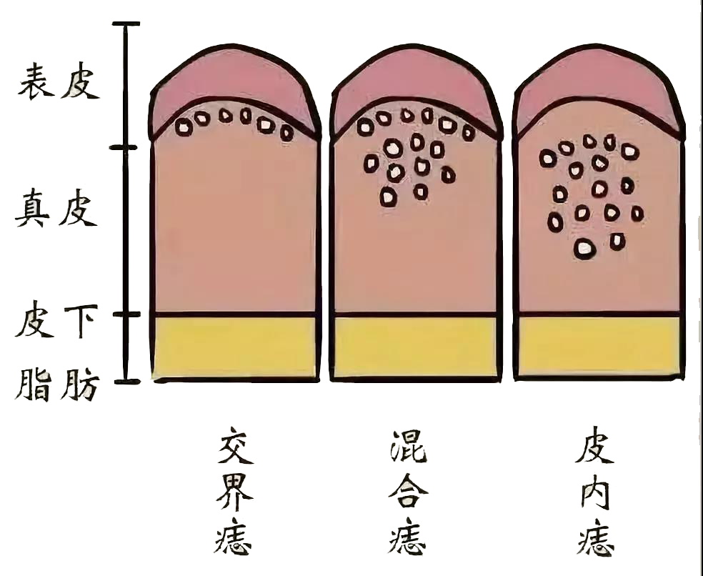 色素痣|有痣别乱点！这2种方法祛痣才靠谱