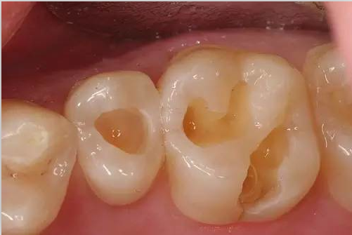 孩子換牙要留心皮皮狗告誡家長做好這些細節