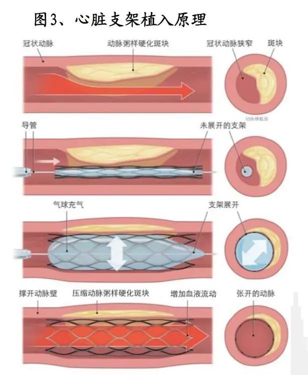 冠脉支架ppt图片