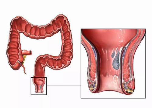 女性直肠癌的早期症状