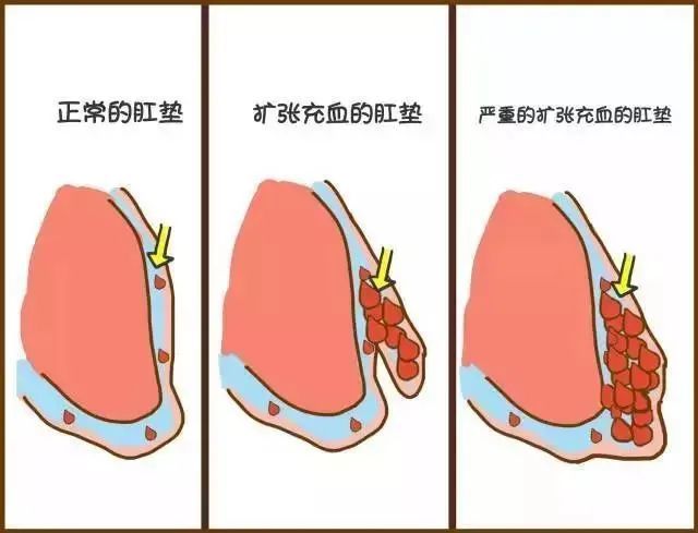 痔瘡到什麼程度需要做手術