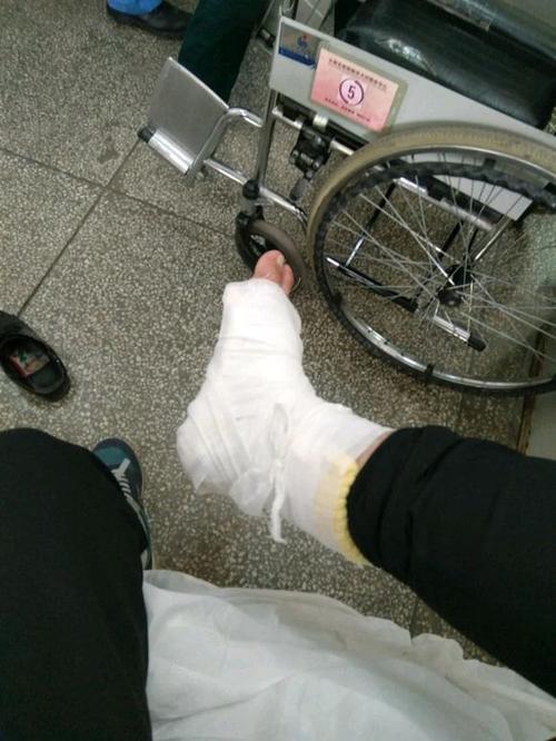 踝关节骨折能恢复如初吗术后康复治疗很关键