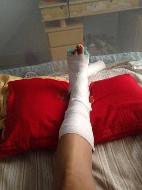 踝关节骨折能恢复如初吗术后康复治疗很关键