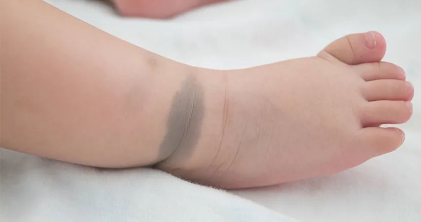 同样是长了胎记为啥我家孩子就需要做手术