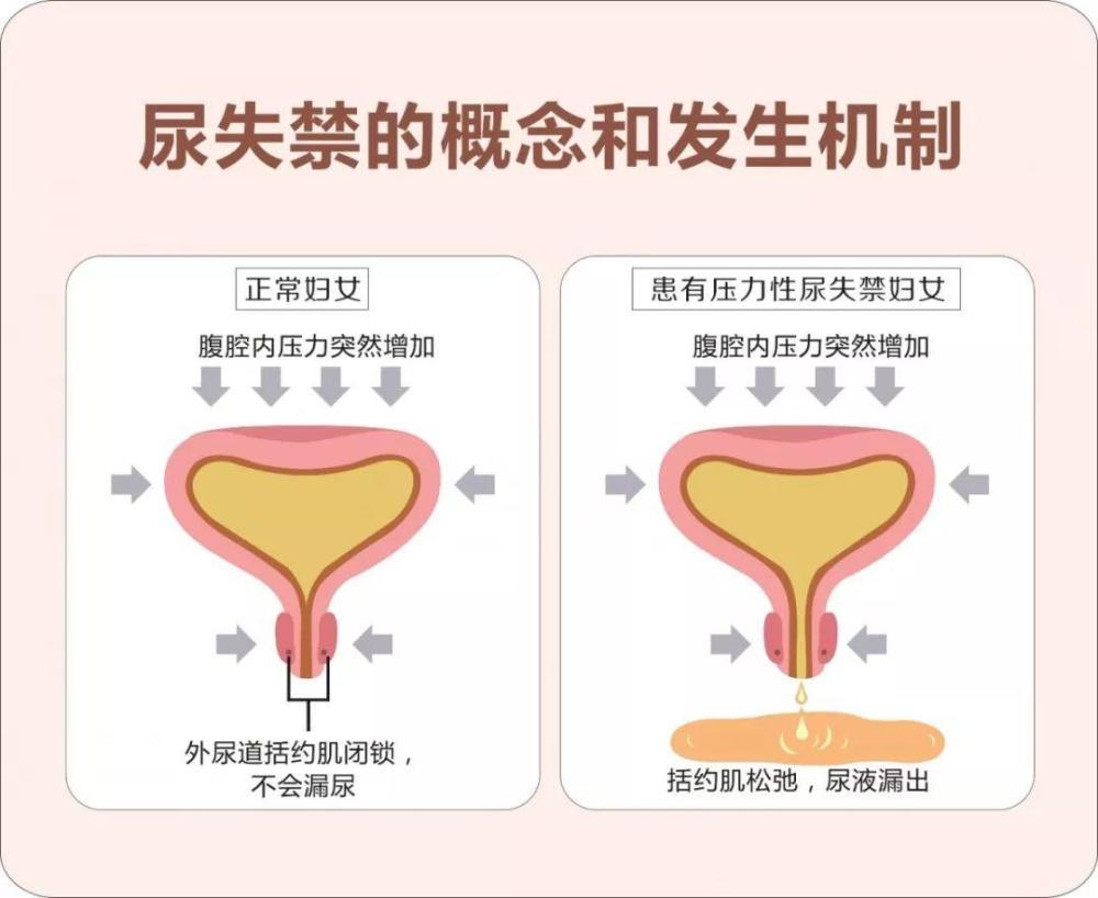 洛阳协和中老年女性尿失禁讲座提升健康素养乐享晚年生活