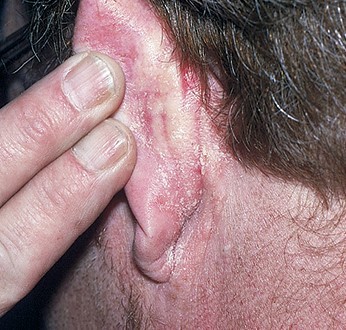 口罩|长时间戴口罩耳朵发红脱皮？一文学会耳部炎症应对