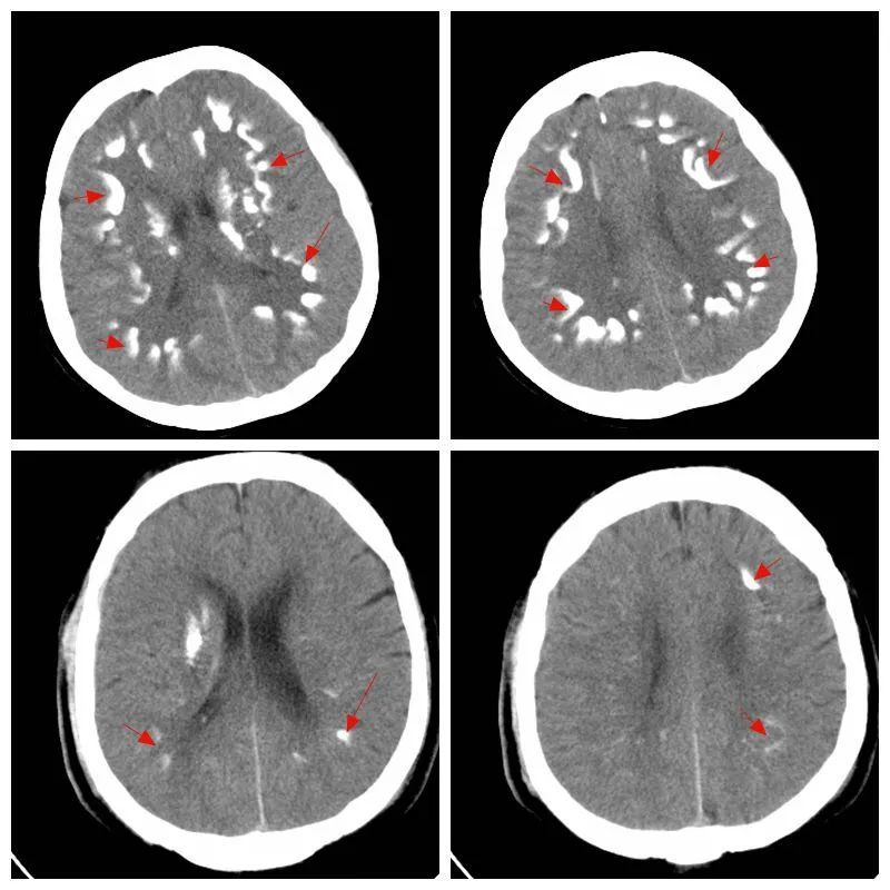 这样的颅内钙化见一次就终身难忘