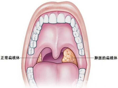 在咽痛阶段,自己的确难判断是急性会厌炎还是其他炎症引起的咽喉肿痛.