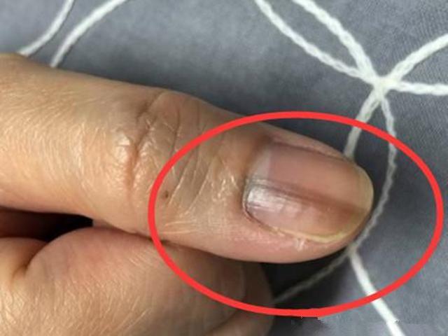 每年37万人死于肝癌手指有3反常你已是肝癌意中人