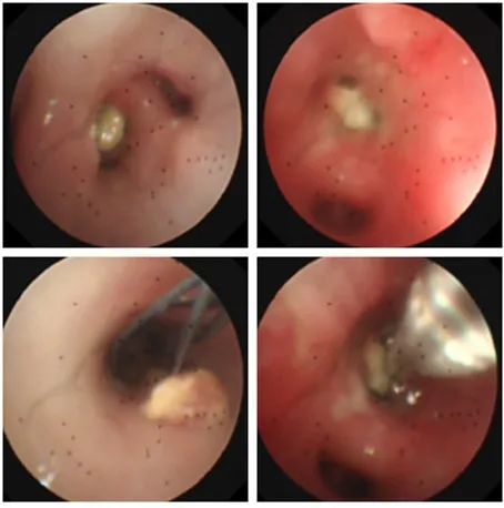 74支气管镜下的异物,取出异物.
