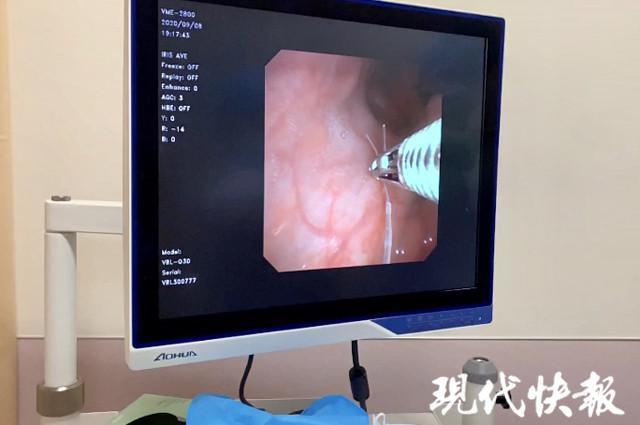 一晚上取鱼刺12次特色门诊解决夜间难言之痛