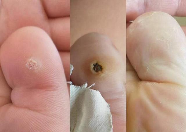 女性注意身上这些疙瘩提示hpv感染要尽快除掉别危及宫颈