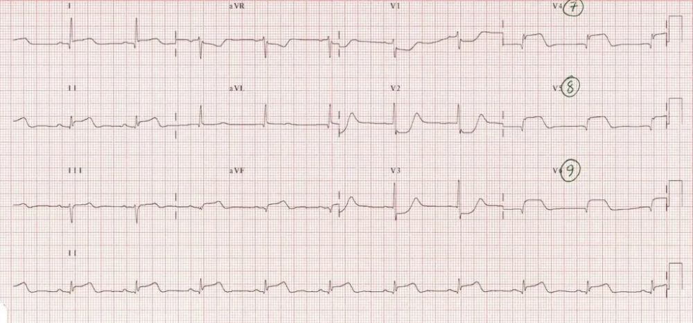 后壁心肌梗死的心电图表现你知晓了吗