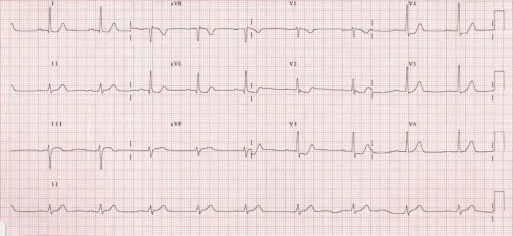 后壁心肌梗死的心电图表现你知晓了吗