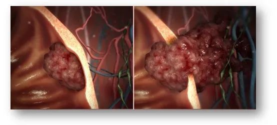 癌症|想不到的身体主宰：肠道菌群失衡可以致癌？