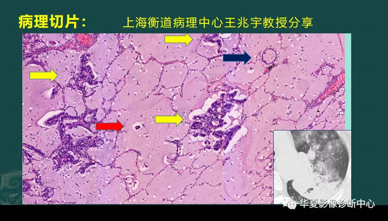 影像科的真相 粘液腺癌细胞会伪装 医生教你用ct扫描抓 贼 腾讯新闻