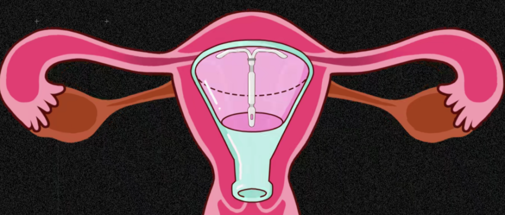 圆环在子宫里的图片图片