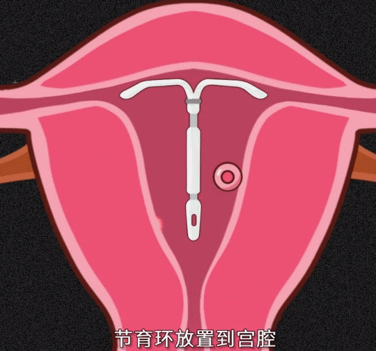 由于子宫内壁不断被节育环刮擦,所以一直处于无菌性发炎状态,导致胚胎