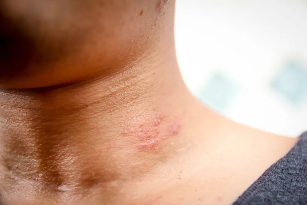 疫苗|比 HPV 更值得警惕的 3 种常见病毒，成年人也要打疫苗预防！