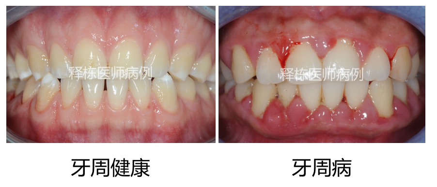 牙龈肿痛|刷牙出血牙龈肿痛，为什么比牙疼更危险？