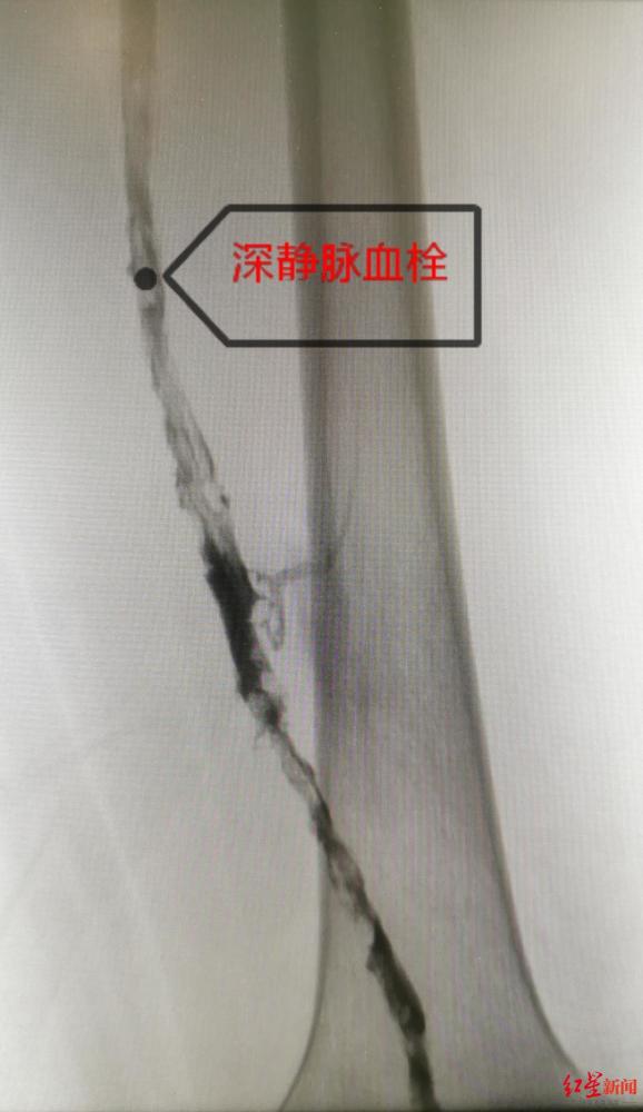 经济舱综合征|连坐10小时，20岁返校大学生腿肿如象！警惕隐形杀手“经济舱综合征”