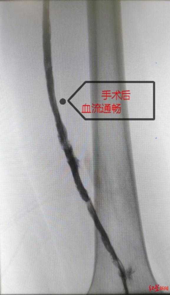 经济舱综合征|连坐10小时，20岁返校大学生腿肿如象！警惕隐形杀手“经济舱综合征”