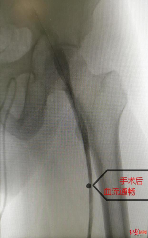 经济舱综合征|连坐10小时，20岁返校大学生腿肿如象！警惕隐形杀手“经济舱综合征”