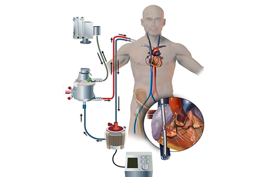 上了ecmo就沒有後顧之憂?抗凝萬萬不能落下!|抗凝|ecmo|復旦大學附屬