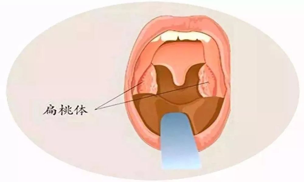 扁桃体反复发炎 割不割主要看这几种情况 腾讯新闻