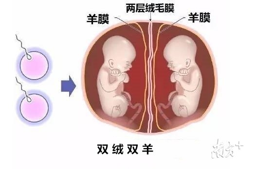 子宫两"房子"住了三宝宝!剖还是不剖?