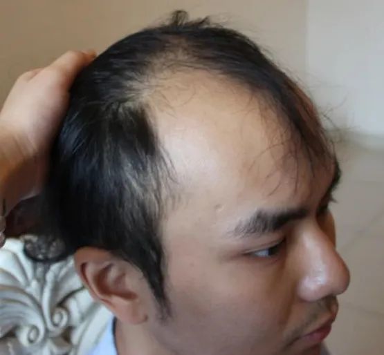 来来来,跟我照着这张脱发等级图做对比,看看您还有救没?